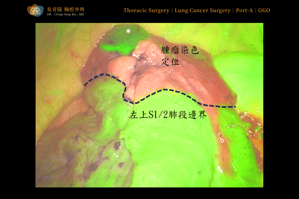 腫瘤染色定位