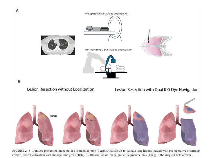 影像導引肺段切除 (I-segmentectomy) 的手術流程