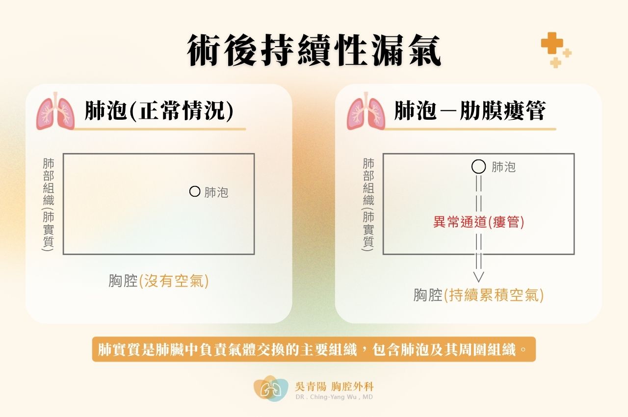 肺泡－肋膜瘻管